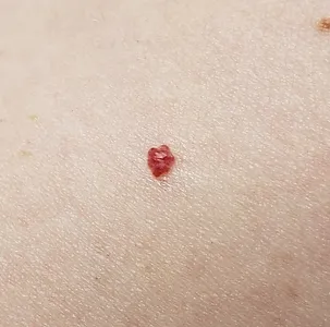 Close-up of a cherry angioma on human skin.