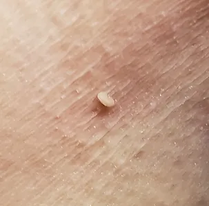 Close-up of a skin tag on human skin.