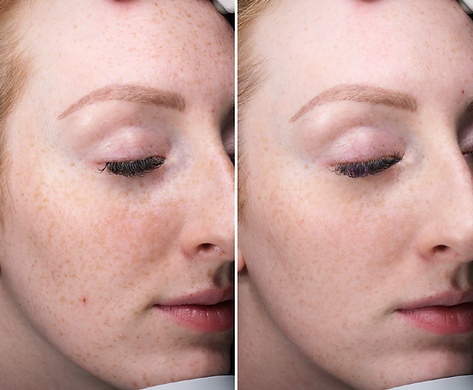 Before and after side-by-side comparison of a young woman's face showing reduced freckles and smoother skin texture after treatment