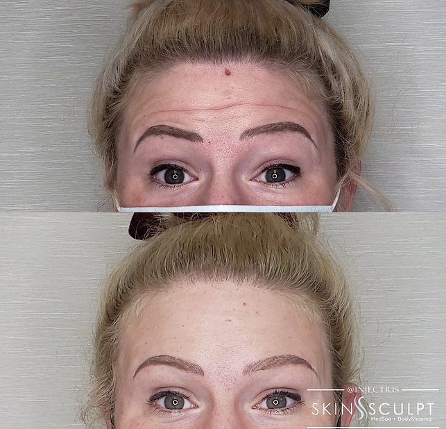 Before and after comparison of a woman's forehead showing reduced wrinkles and smoother skin after treatment.