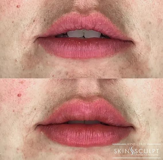 Before and after comparison of a woman's lips showing fuller, smoother appearance after lip enhancement treatment