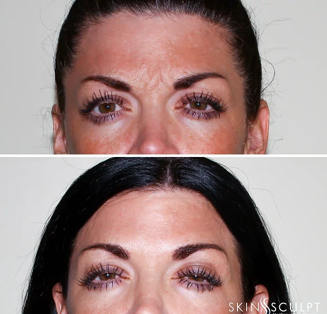 Before and after comparison of a woman's forehead showing reduced frown lines after treatment, with the woman looking directly at the camera in both images.