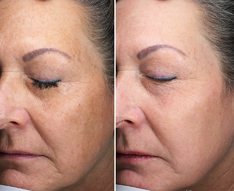 Side-by-side comparison of an older woman's face showing reduced wrinkles and improved skin texture after treatment
