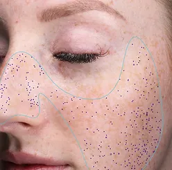 Close-up of a woman's face with marked areas during a skin analysis