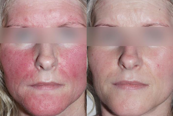 Before and after comparison of a woman's face with and without facial redness