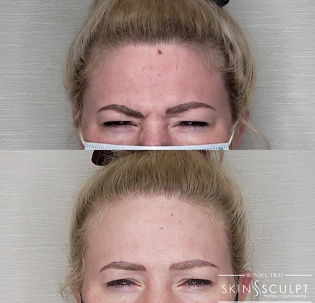 Before and after comparison of a woman's forehead showing reduced frown lines after Botox and Dysport treatment.