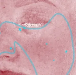 Close-up of a woman's face with marked areas during a skin analysis