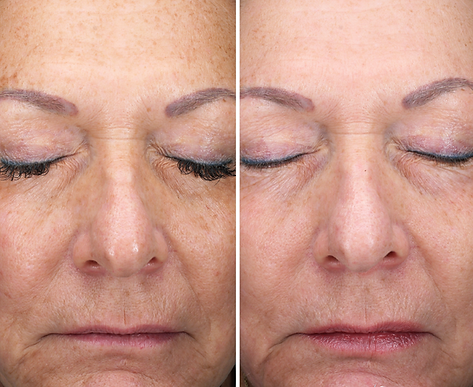 Before and after comparison of an older woman's face showing reduced wrinkles and improved skin texture.