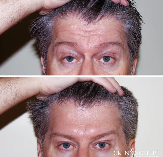 Before and after comparison of a man's forehead showing reduced wrinkles after treatment, with the man holding his hair back in both images