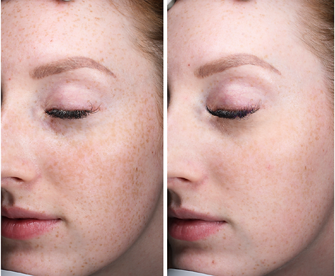 Before and after side-by-side comparison of a young woman's face showing reduced freckles and smoother skin texture after treatment.