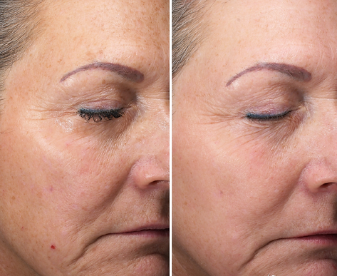 Before and after close-up side view comparison of an older woman's face showing reduced wrinkles and smoother skin after treatment