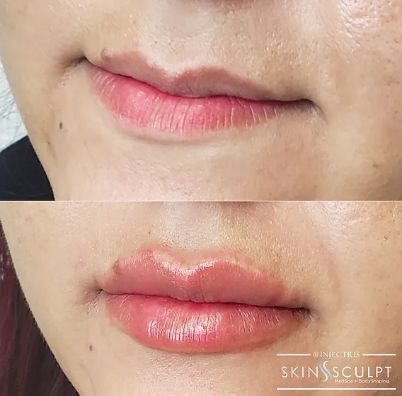 Before and after comparison of a woman's lips showing fuller, smoother appearance after lip enhancement treatment.