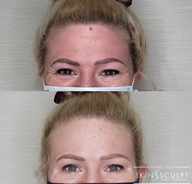 Before and after comparison of a woman's forehead showing reduced wrinkles and smoother skin after Botox and Dysport treatment.