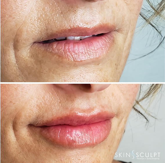 Before and after comparison of a woman's lips showing fuller, smoother appearance after lip enhancement treatment.