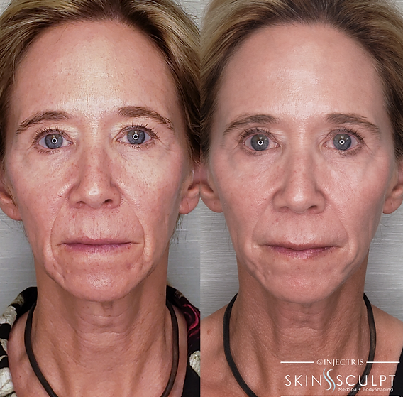 Before and after comparison of a woman's face showing reduced wrinkles and smoother skin after facial rejuvenation treatment.