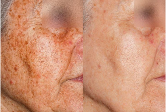 Before and after comparison of an older person's face with and without age spots