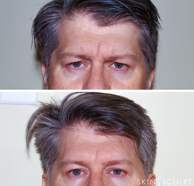 Before and after comparison of a man's forehead showing reduced frown lines after treatment, with the man looking directly at the camera in both images