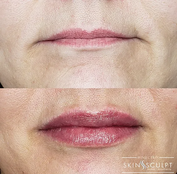 Before and after comparison of a woman's lips showing fuller, smoother appearance after treatment."