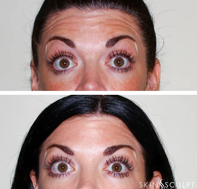 Before and after comparison of a woman's forehead showing reduced wrinkles and smoother skin after treatment, with the woman looking directly at the camera in both images.