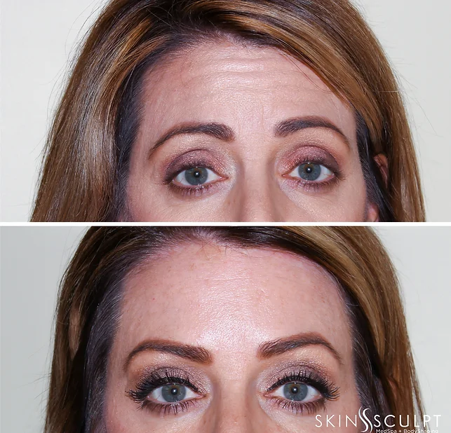 Before and after comparison of a woman's eyes and forehead showing reduced wrinkles after treatment.