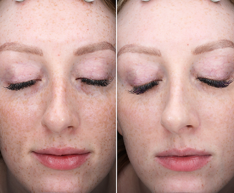 Before and after close-up comparison of a young woman's face showing reduced freckles and improved skin texture after treatment.