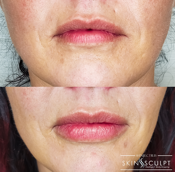 Before and after comparison of a woman's lips showing fuller, smoother appearance after lip enhancement treatment