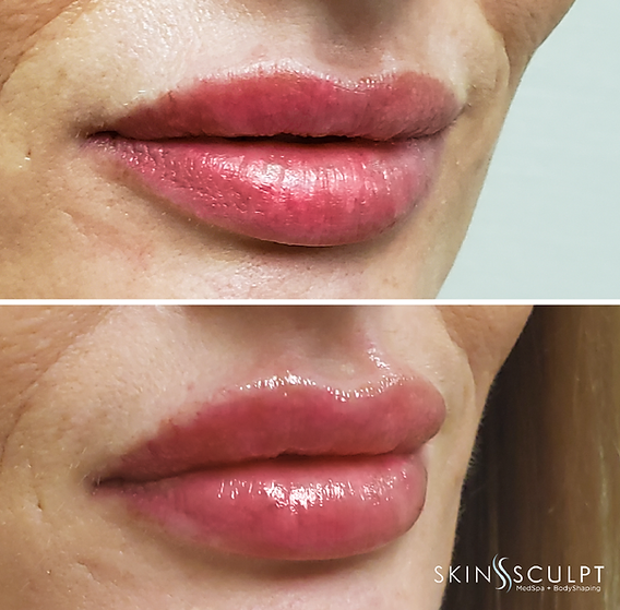 Before and after comparison of a woman's lips showing fuller, smoother appearance after lip enhancement treatment.