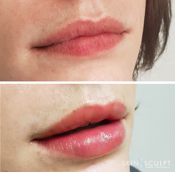 Before and after comparison of a woman's lips showing fuller, smoother appearance after lip enhancement treatment.