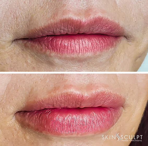 Before and after comparison of a woman's lips showing fuller, smoother appearance after lip enhancement treatment.