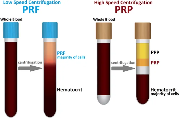 Diagram comparing low speed centrifugation (PRF) and high speed centrifugation (PRP) for blood separation