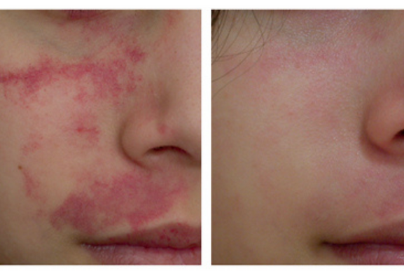 Before and after photos of a child's cheek showing skin treatment results