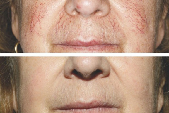 Before and after treatment of facial redness on a woman's nose and cheeks.